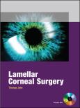 Lamellar Corneal Surgery. Text with DVD