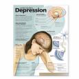 Understanding Depression. 20x26 Laminated Chart
