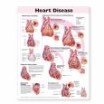 Heart Disease. 20X26 Laminated Chart
