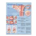 Understanding Ovarian Cancer. 20X26 Paper Chart.