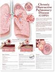 Chronic Obstructive Pulmonary Disease (COPD). 20X26 Paper Chart.
