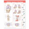 Athletic Injuries of the Knee Anatomical Chart. 20X26 Laminated Chart.