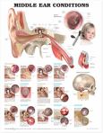 Middle Ear Conditions. 20X26 Laminated Chart.
